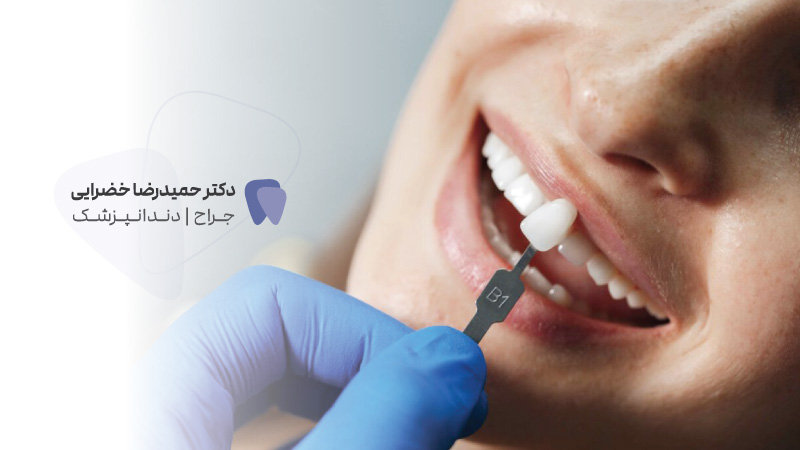لمینت دندان