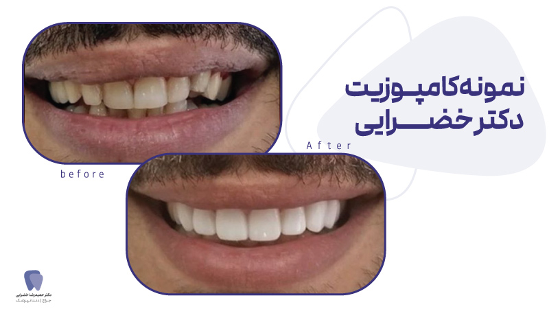 هزینه ایمپلنت دندان