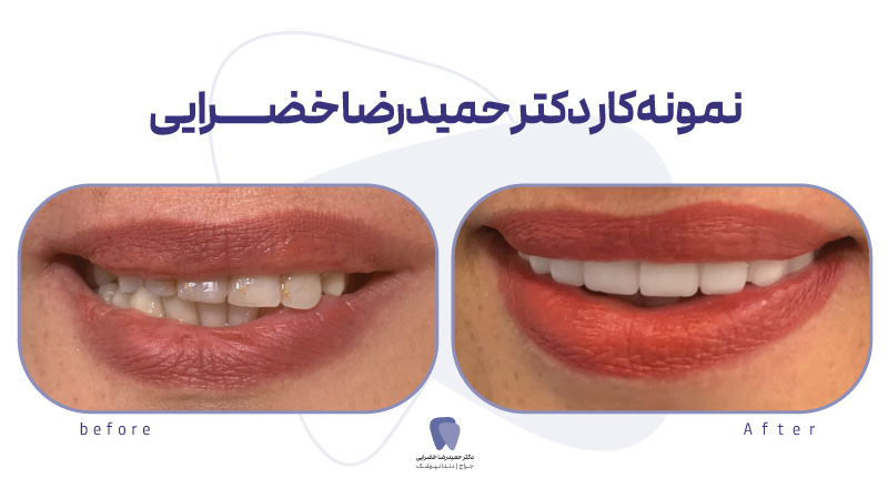 اصلاح طرح لبخند