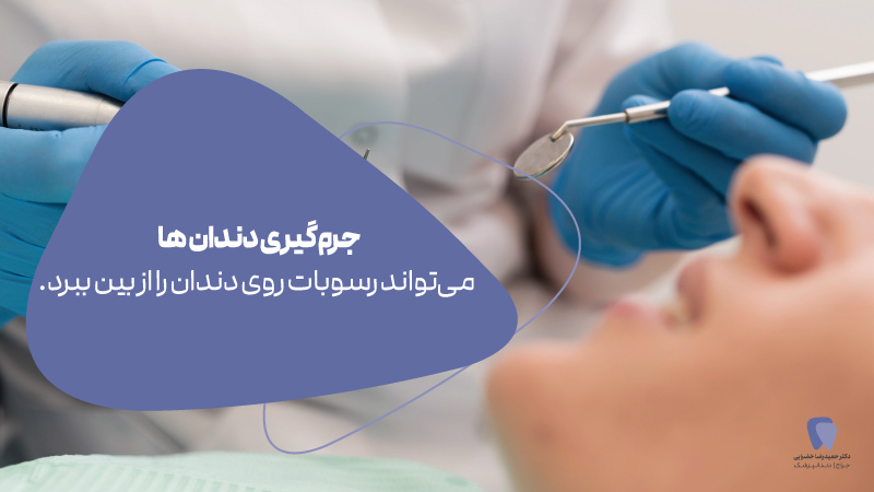 جرم گیری دندان