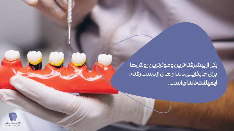 انواع ایمپلنت دندان